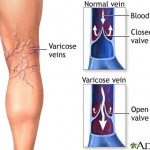 Varicose Veins Treatment